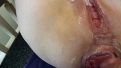 Anal Bitch Takes Penis In Her MButtive Prolapsed Butt